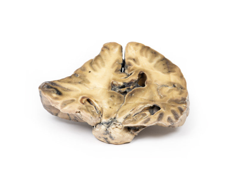 Intracranial space-occupying lesion