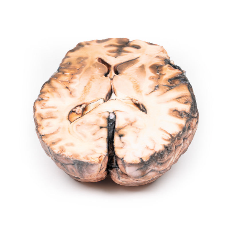 Ruptured Berry Aneurysm