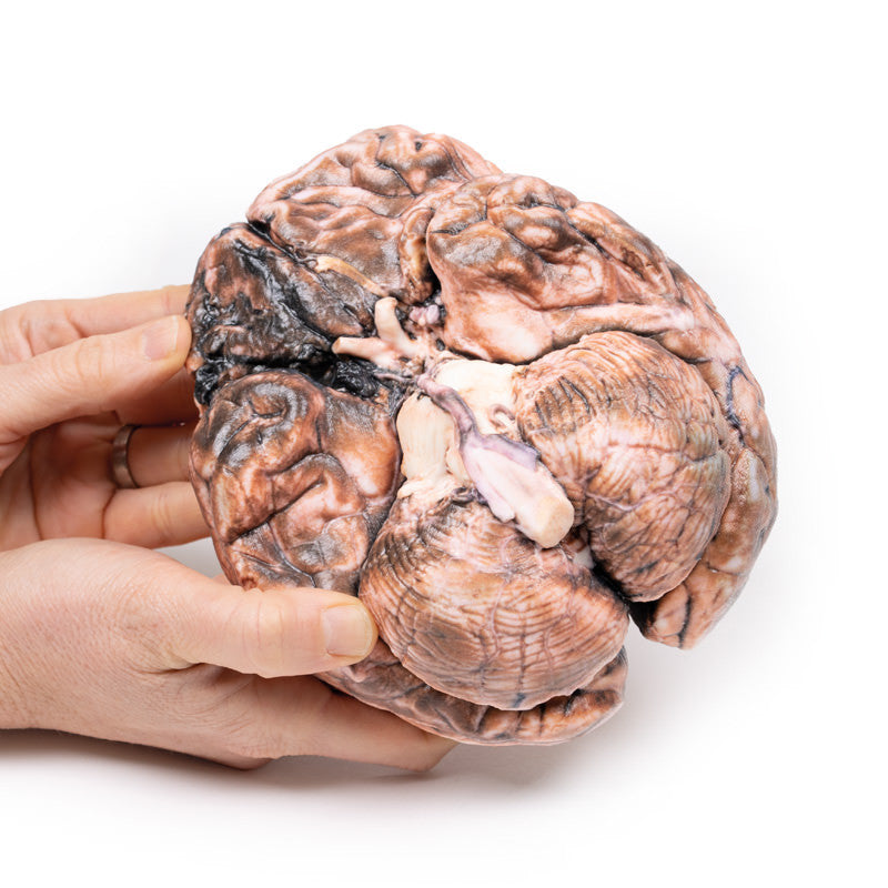 Ruptured Berry Aneurysm