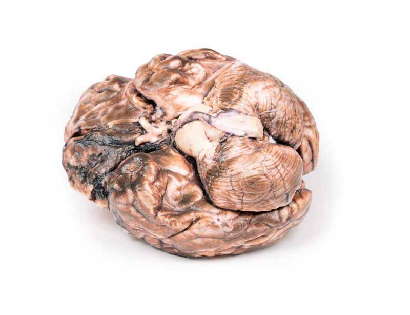 Ruptured Berry Aneurysm