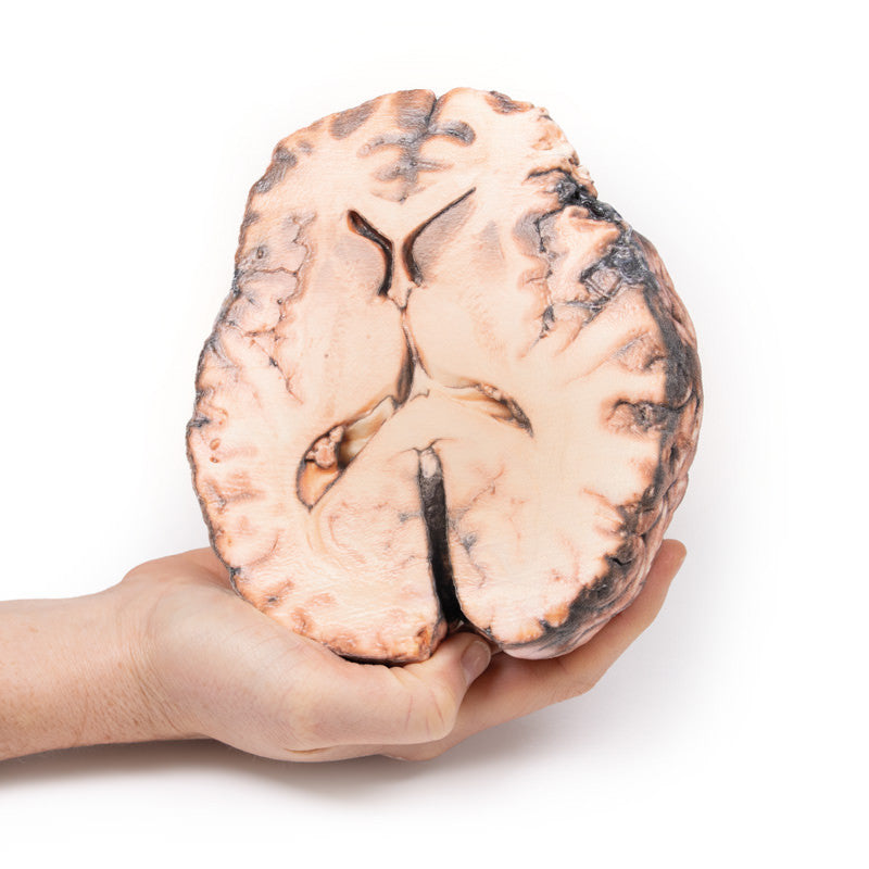 Ruptured Berry Aneurysm