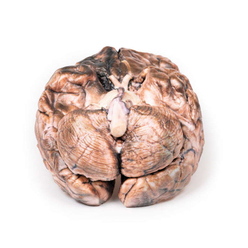 Ruptured Berry Aneurysm