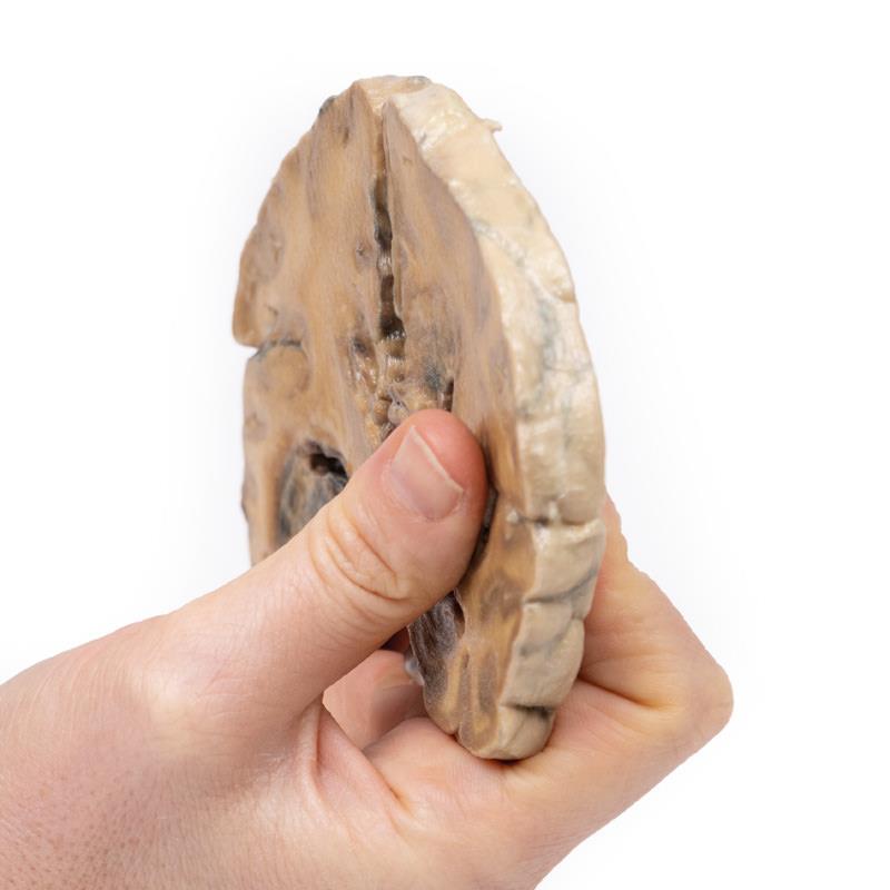 Glioblastoma multiforme