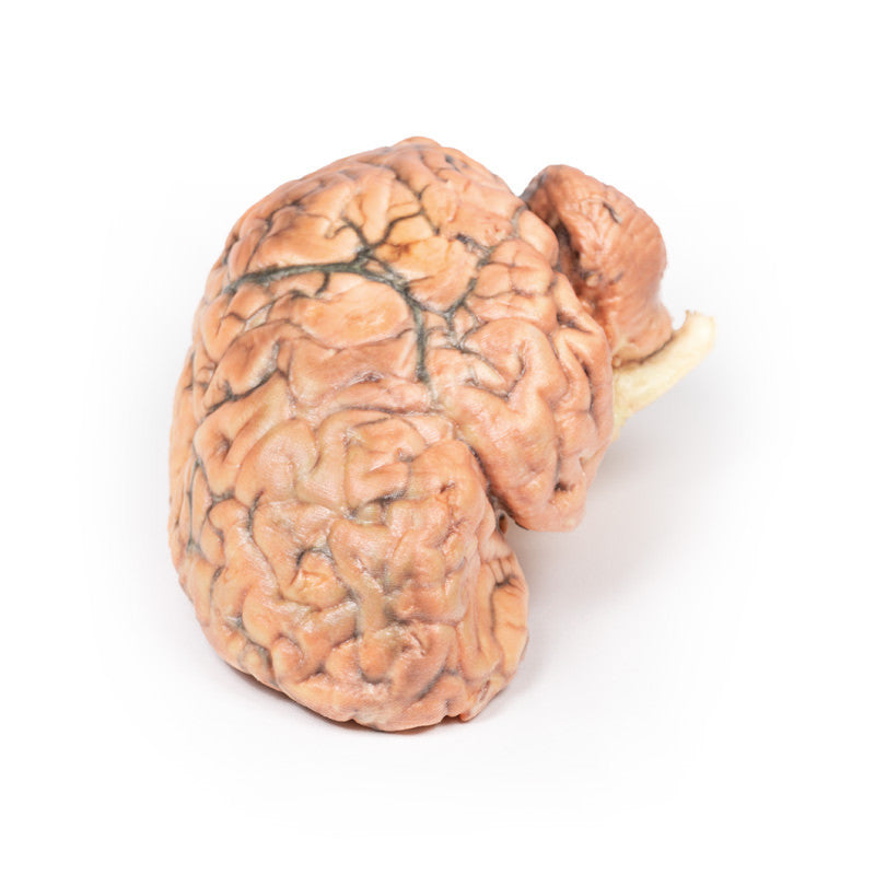 Craniopharyngioma