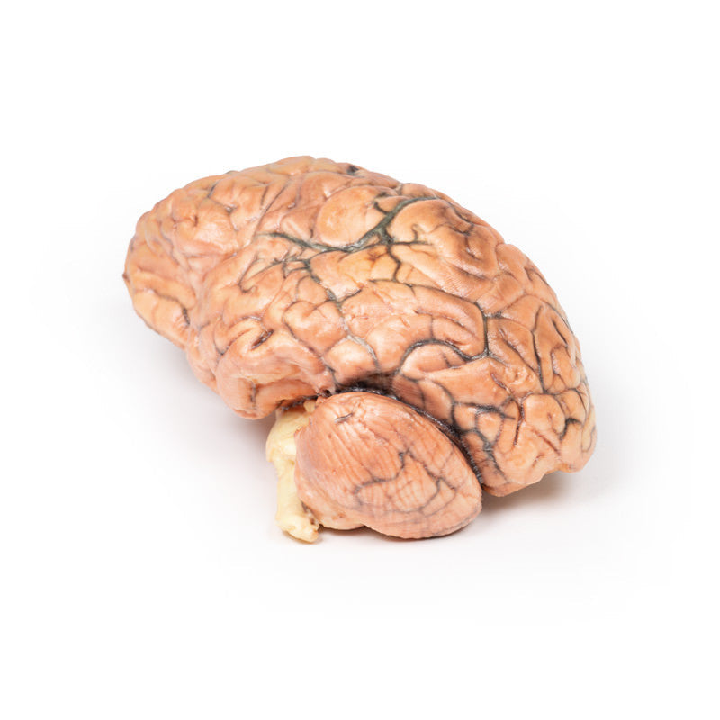 Craniopharyngioma