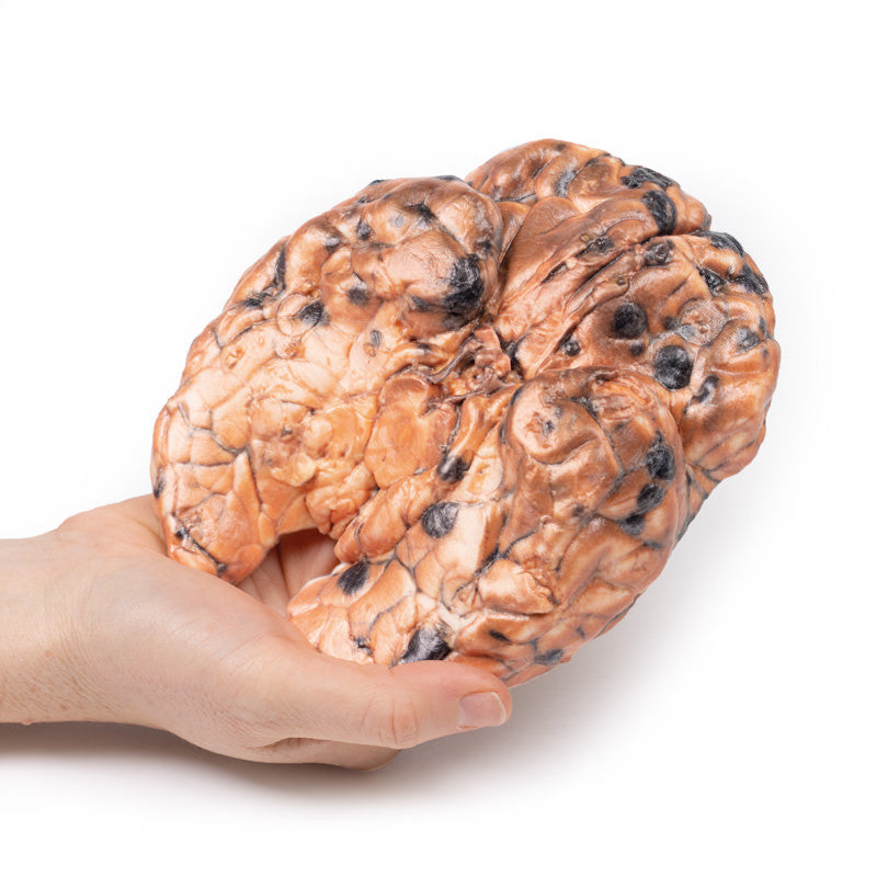 Metastatic melanoma