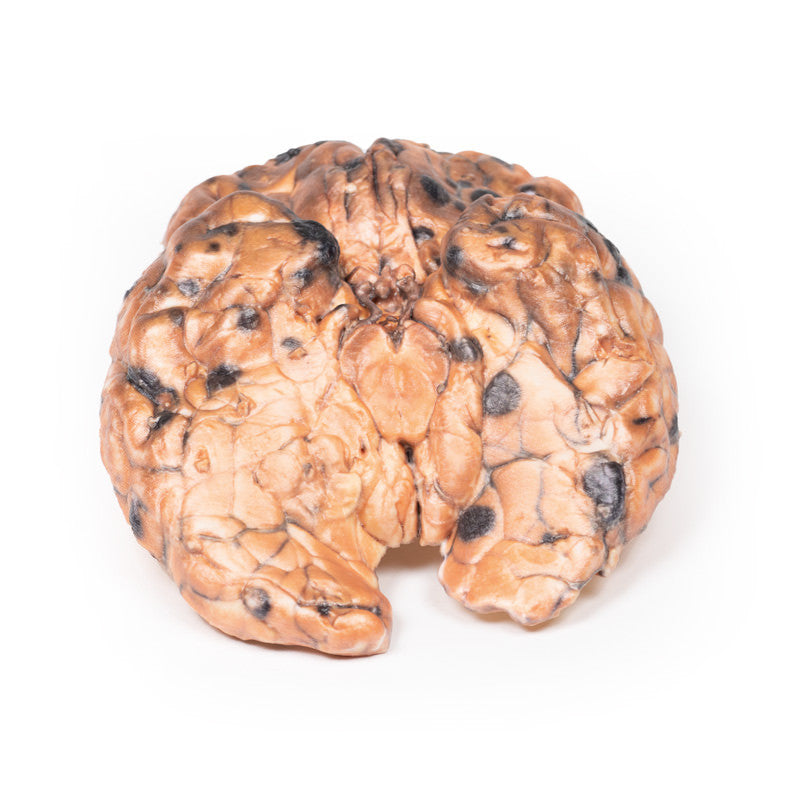 Metastatic melanoma
