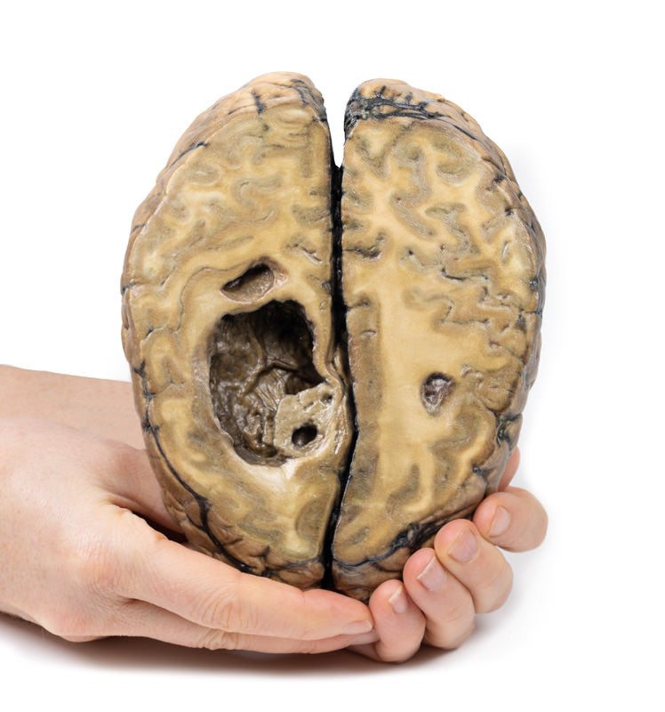 Metastatic carcinoma in the brain