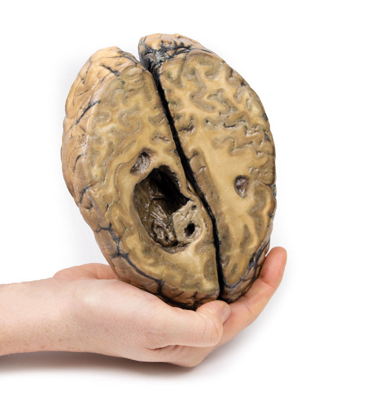 Metastatic carcinoma in the brain