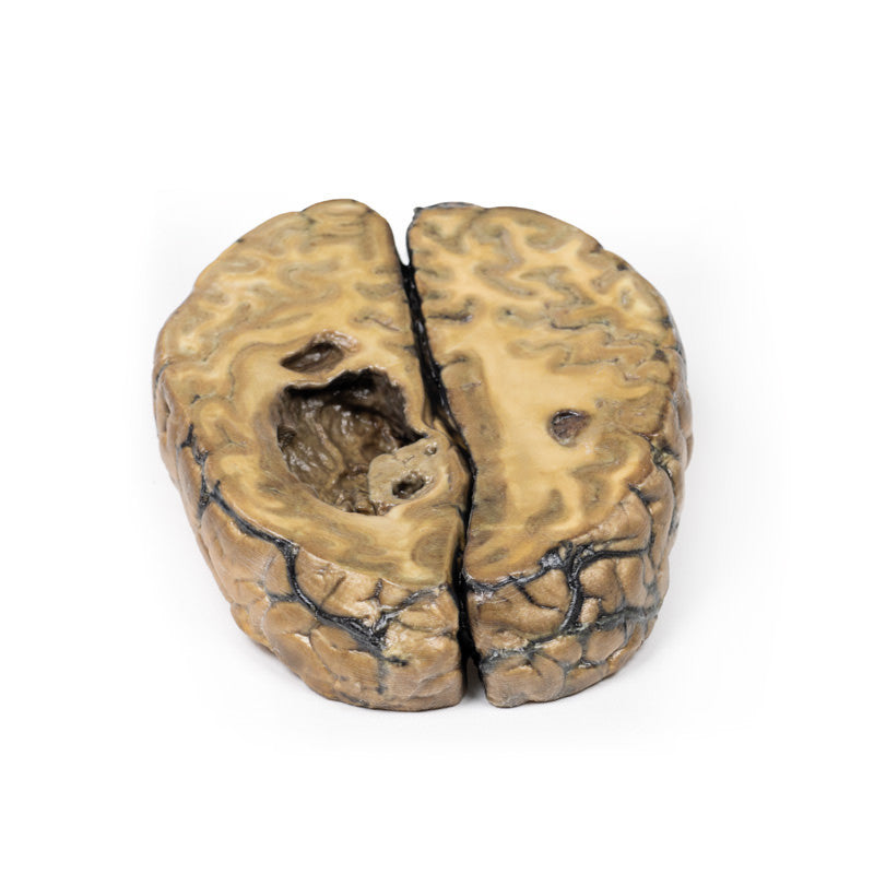 Metastatic carcinoma in the brain