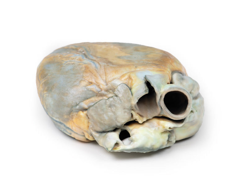 Right Ventricular Hypertrophy