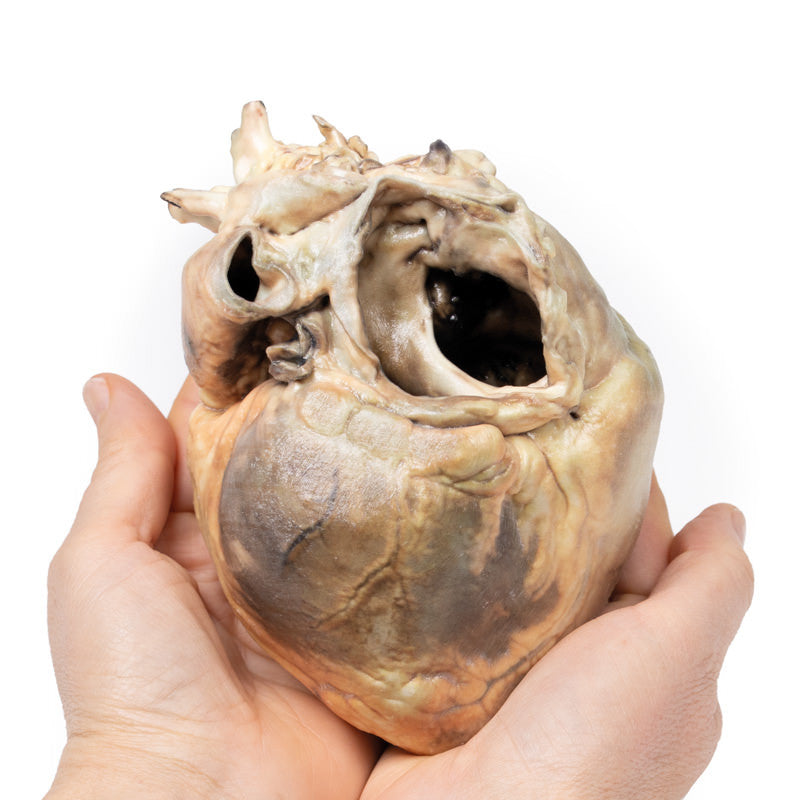 Atrial septal defect