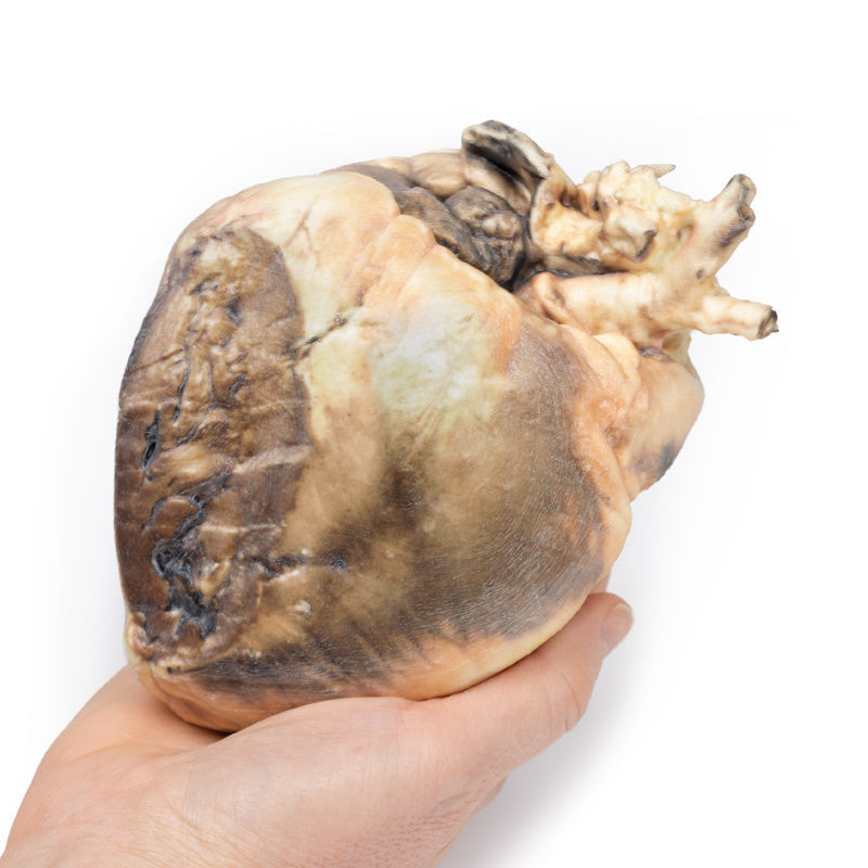 Atrial septal defect