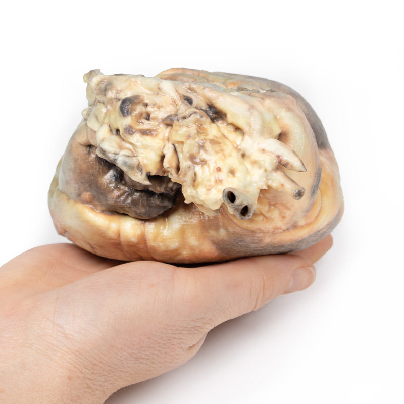 Atrial septal defect