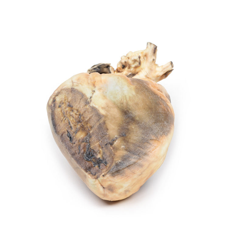 Atrial septal defect