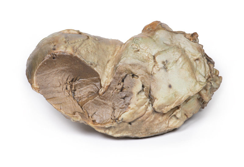 Bicuspid Aortic Valve