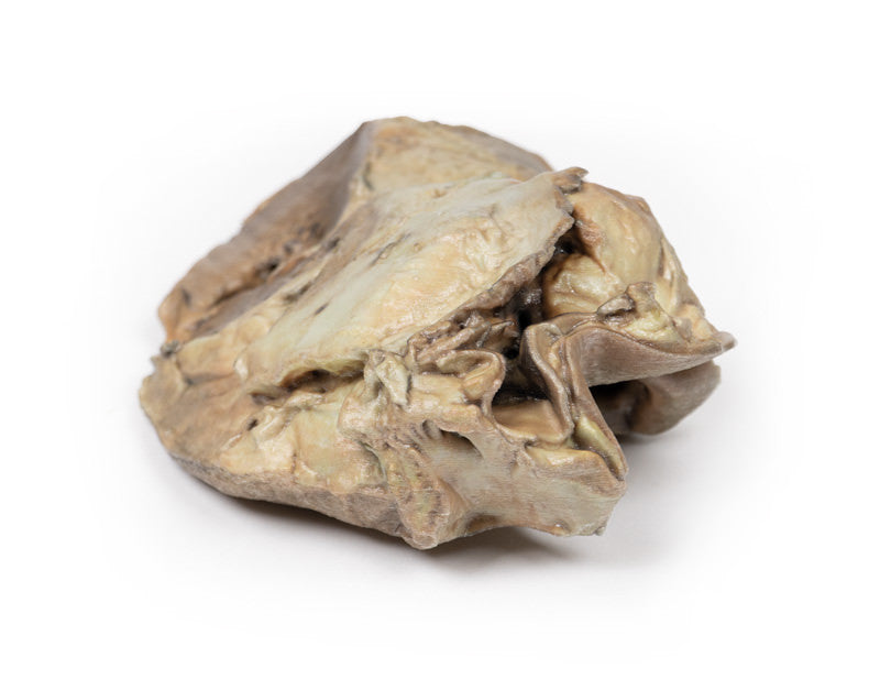 Bicuspid Aortic Valve