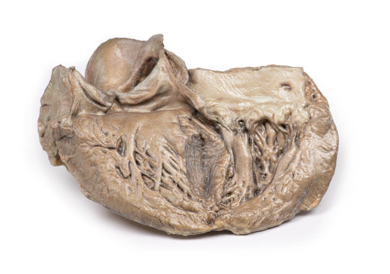 Bicuspid Aortic Valve