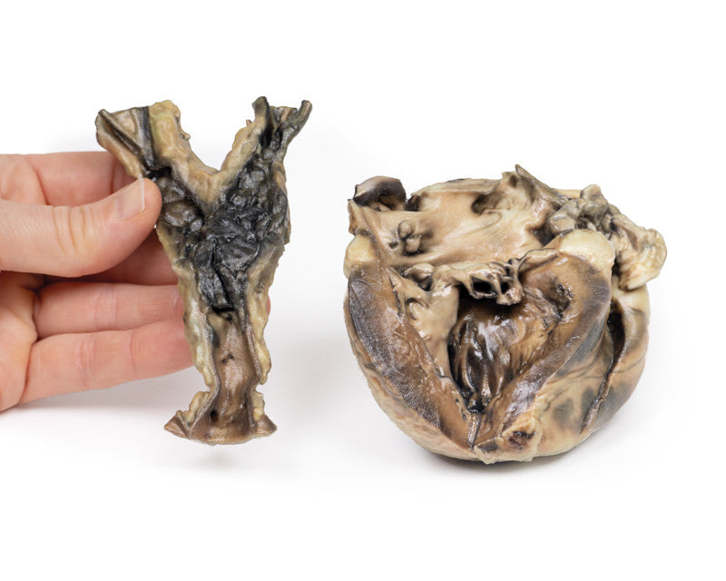 Hydatid Disease Affecting the Heart and Aorta