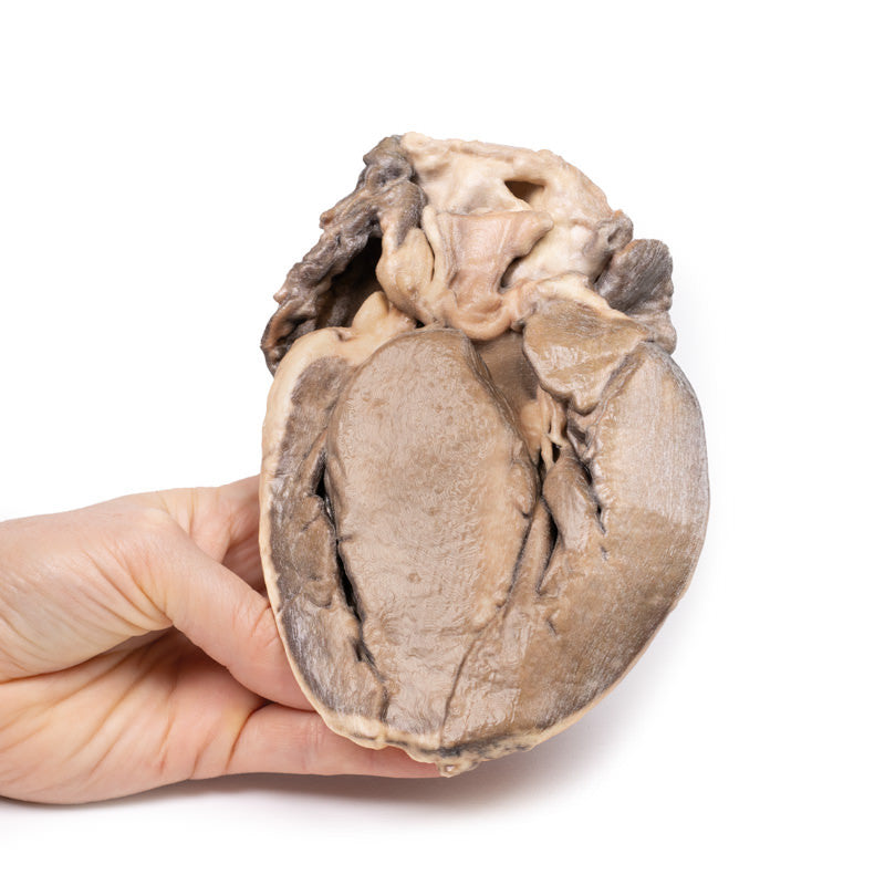 Hypertrophic Subaortic stenosis