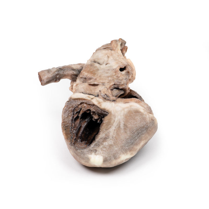 Tetralogy of Fallot
