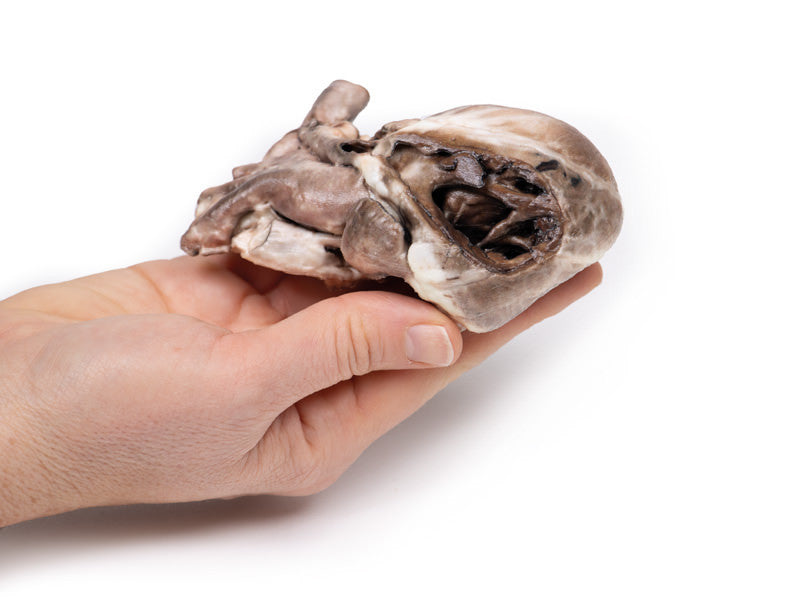 Tetralogy of Fallot