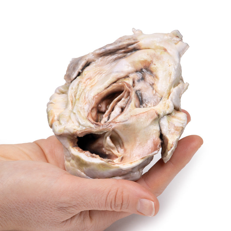 Calcified Aortic Valvular Stenosis Bicuspid Aortic Valve