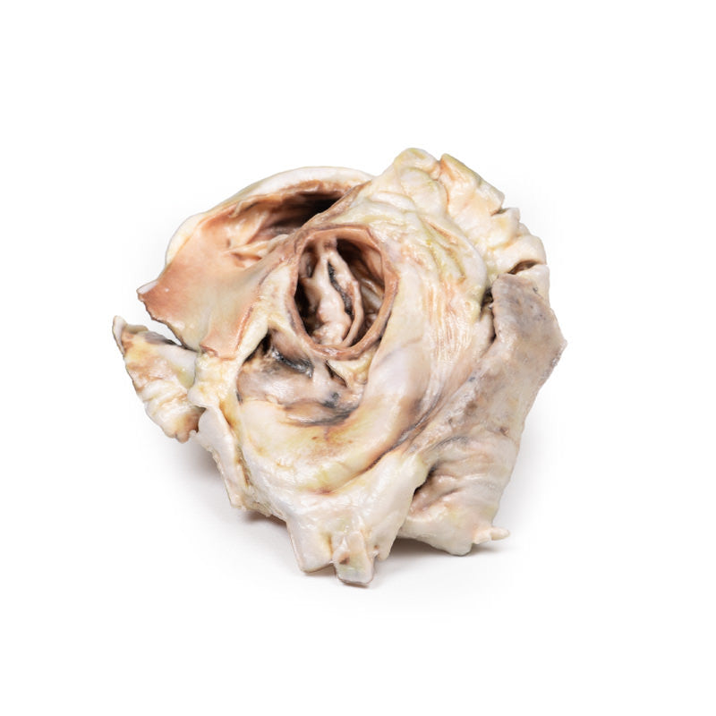 Calcified Aortic Valvular Stenosis Bicuspid Aortic Valve