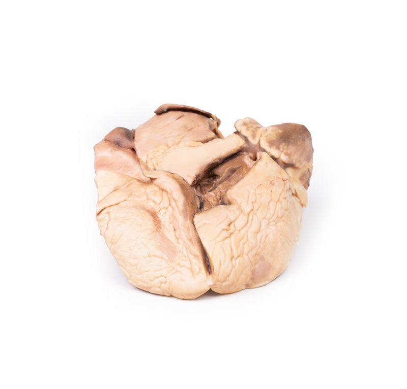 Rheumatic endocarditis