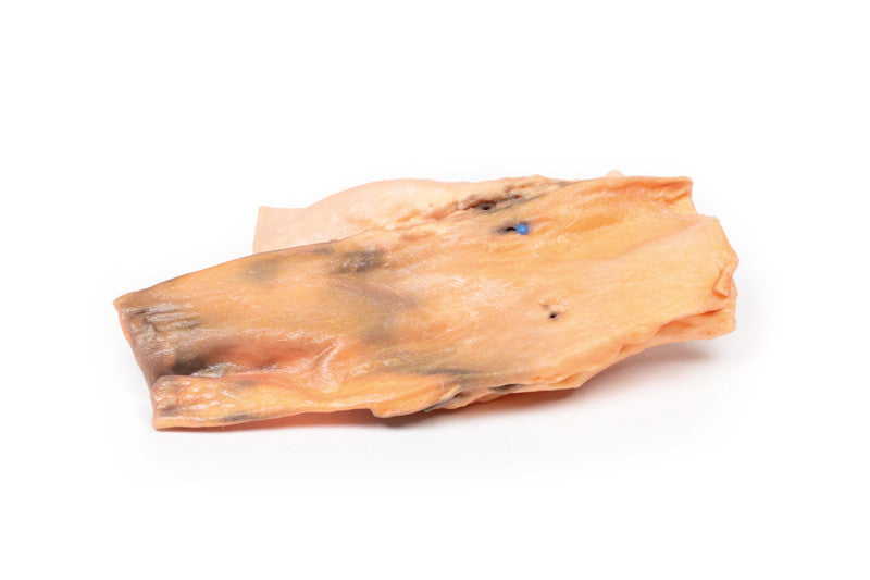 Traumatic Oesophageal-aortic fistula