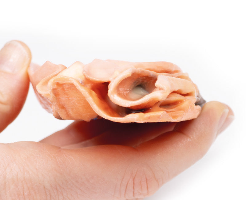 Traumatic Oesophageal-aortic fistula