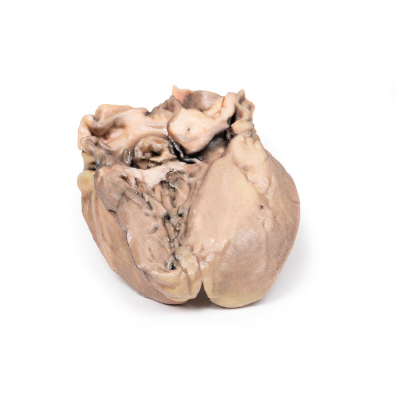 Acute Bacterial Endocarditis