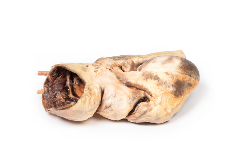 Syphilitic Aneurysm