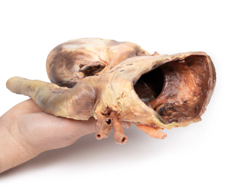 Syphilitic Aneurysm