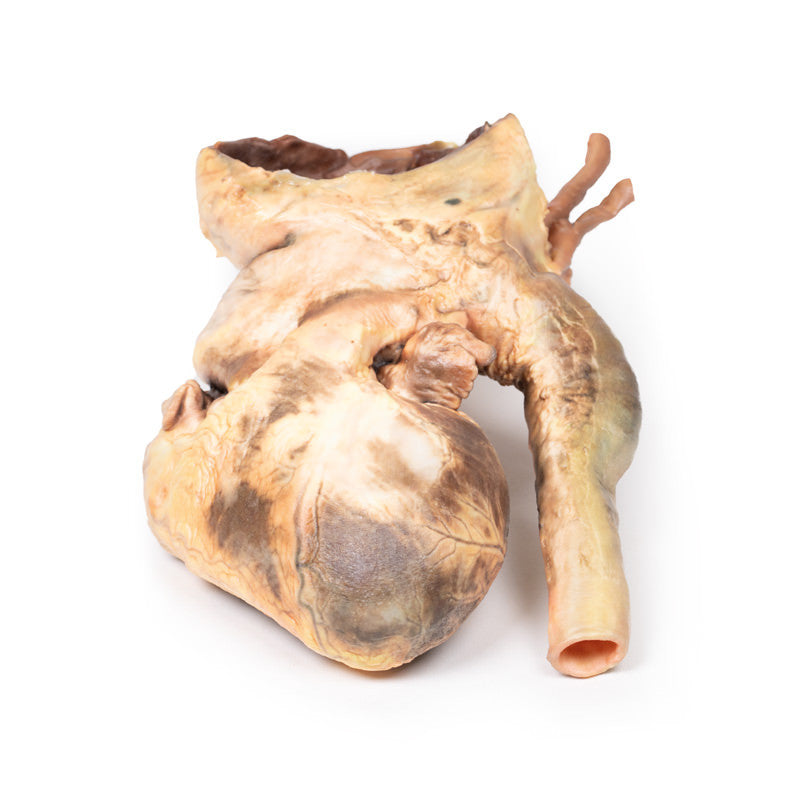 Syphilitic Aneurysm