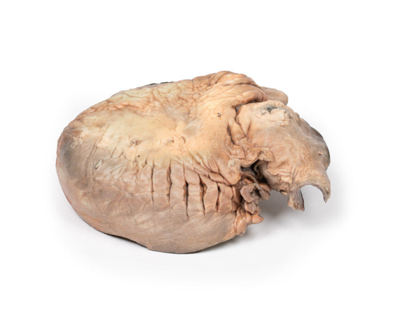 Ruptured Thoracic Aortic Aneurysm
