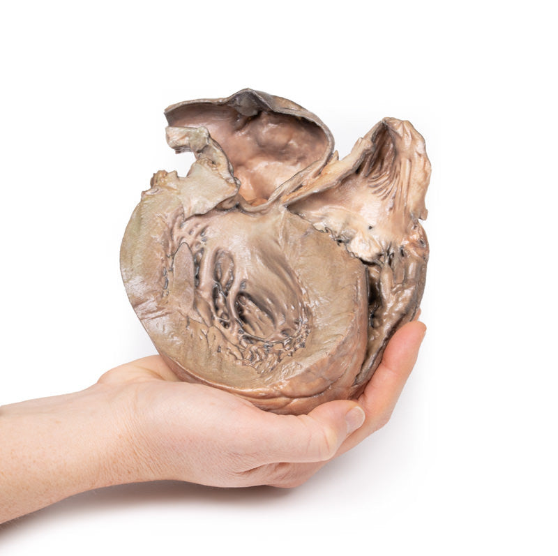 Ruptured Thoracic Aortic Aneurysm