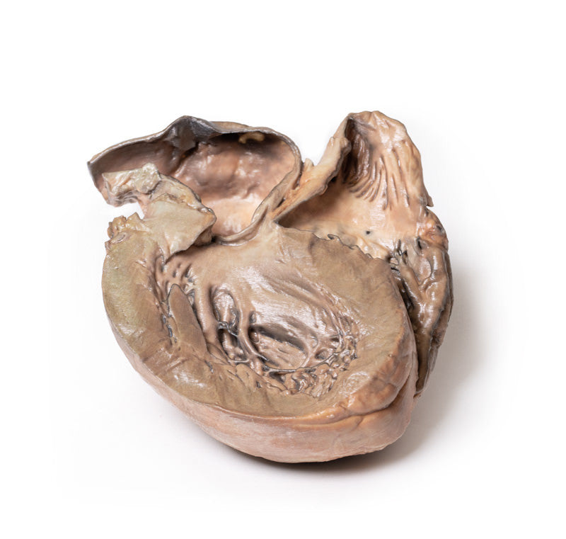 Ruptured Thoracic Aortic Aneurysm