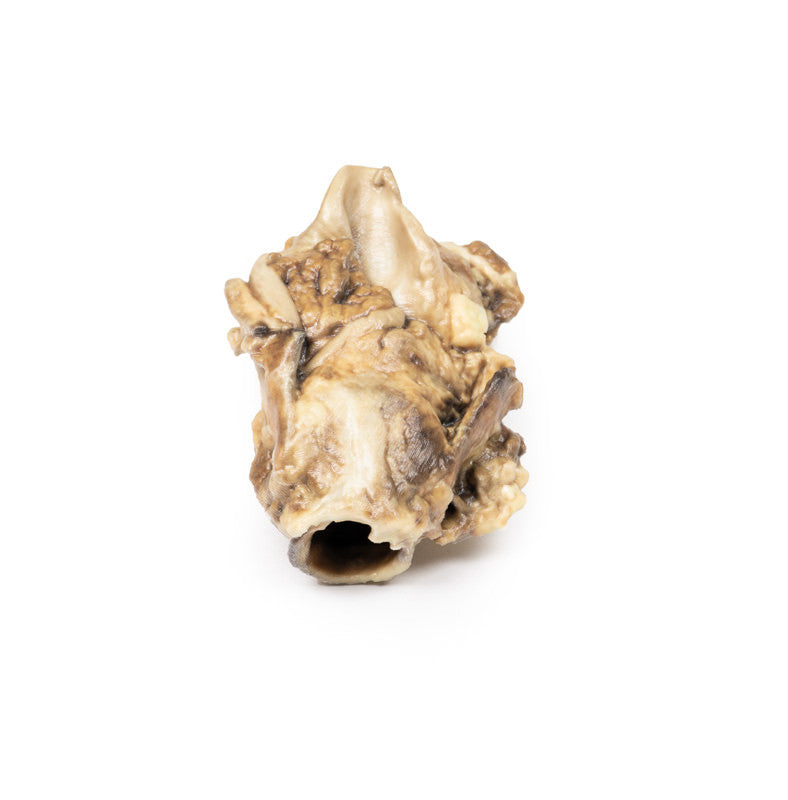 Carcinoma of Pyriform Fossa
