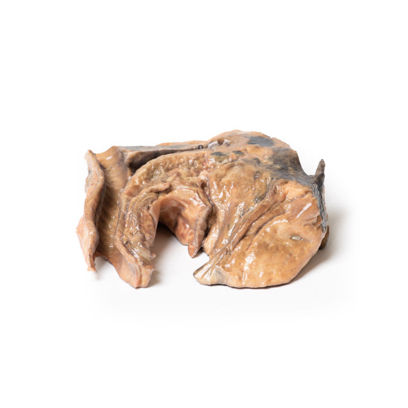 Inhaled Foreign Body-trachea