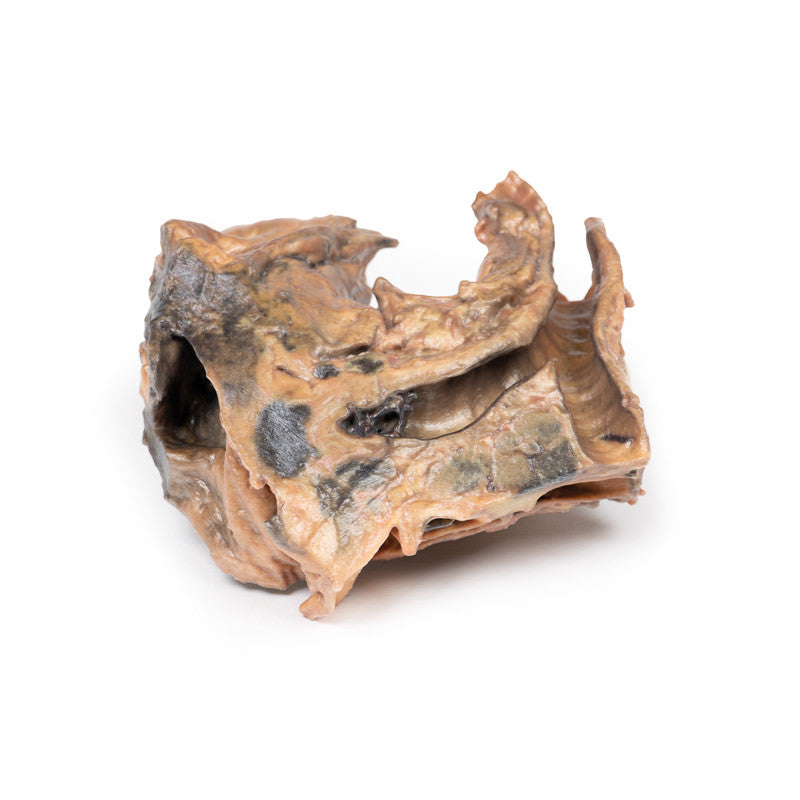 Inhaled Foreign Body-trachea