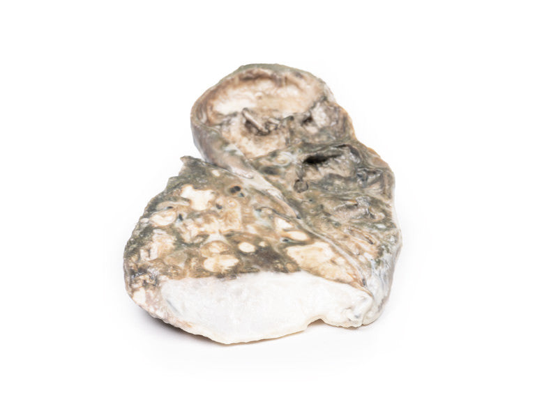 Fibrocaseous Tuberculosis