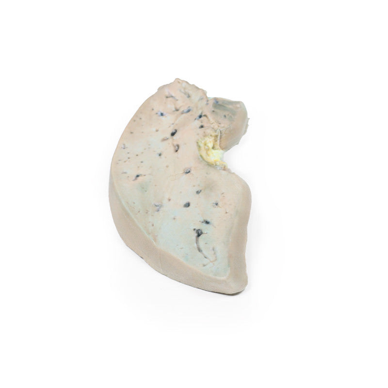 Fatty Liver