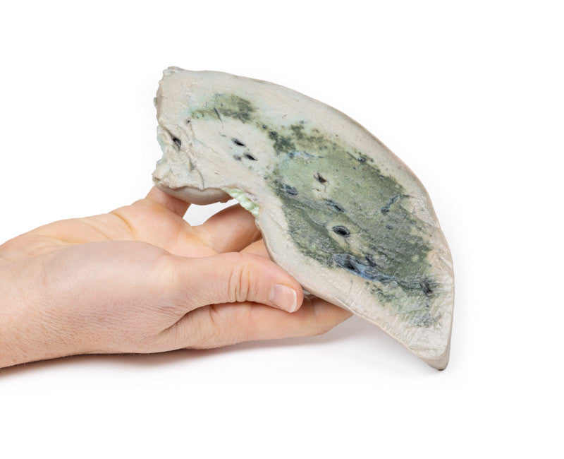 Fatty Liver