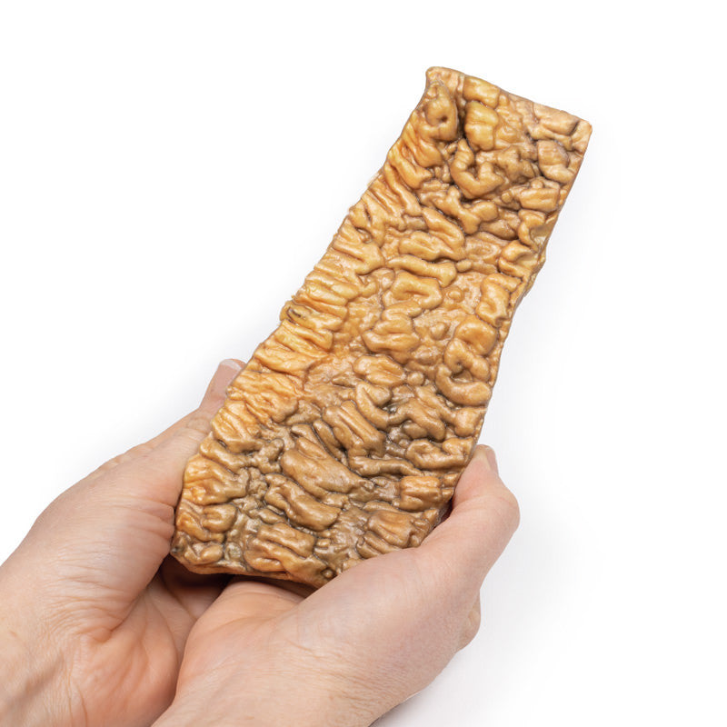 Ulcerative Colitis