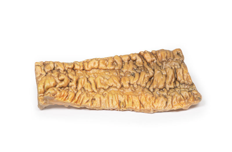 Ulcerative Colitis