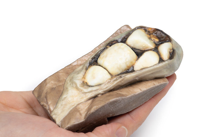 Cholelithiasis (Gallstones)