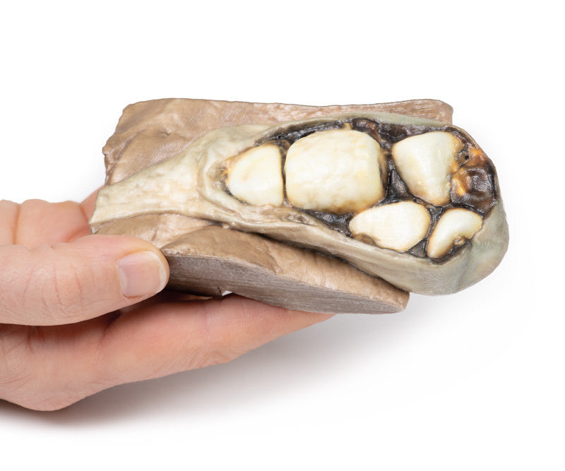 Cholelithiasis (Gallstones)