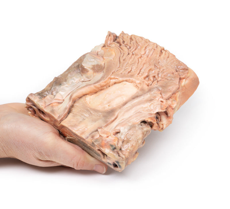 Chronic Gastric Ulcer
