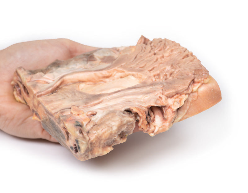 Chronic Gastric Ulcer